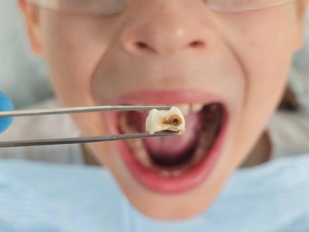 Best Emergency Tooth Extraction in Hyde Rk, PA